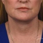Facelift Before & After Patient #882