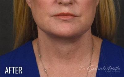 Facelift Before & After Patient #882