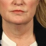 Facelift Before & After Patient #882