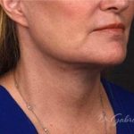 Facelift Before & After Patient #882