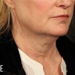 Facelift Before & After Patient #882
