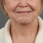 Facelift Before & After Patient #881