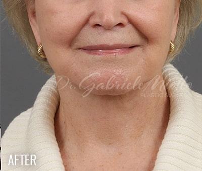 Facelift Before & After Patient #881