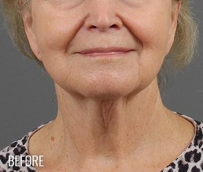 Facelift Before & After Patient #881