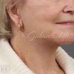 Facelift Before & After Patient #881