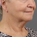 Facelift Before & After Patient #881