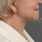 Facelift Before & After Patient #881