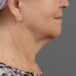 Facelift Before & After Patient #881