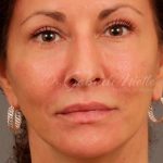 Facelift Before & After Patient #880