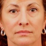Facelift Before & After Patient #880
