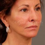 Facelift Before & After Patient #880