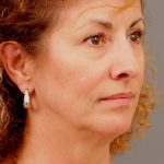Facelift Before & After Patient #880