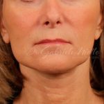 Facelift Before & After Patient #885