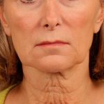 Facelift Before & After Patient #885