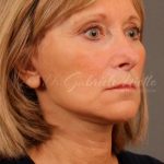 Facelift Before & After Patient #885