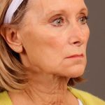 Facelift Before & After Patient #885