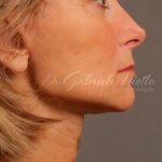 Facelift Before & After Patient #885