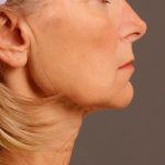 Facelift Before & After Patient #885