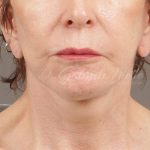 Facelift Before & After Patient #879