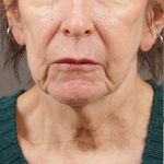 Facelift Before & After Patient #879