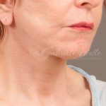Facelift Before & After Patient #879