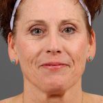 Facelift Before & After Patient #886