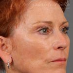 Facelift Before & After Patient #886