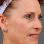 Facelift Before & After Patient #886