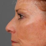 Facelift Before & After Patient #886