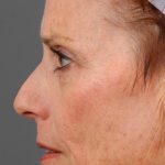 Facelift Before & After Patient #886