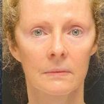 Facelift Before & After Patient #887