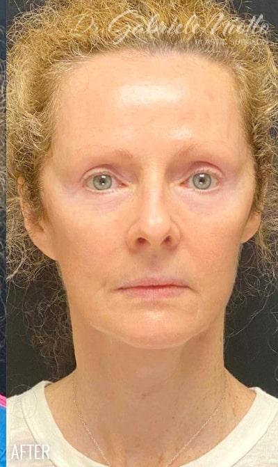 Facelift Before & After Patient #887