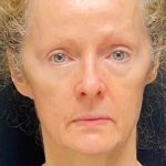 Facelift Before & After Patient #887