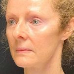 Facelift Before & After Patient #887