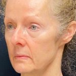 Facelift Before & After Patient #887