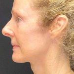 Facelift Before & After Patient #887