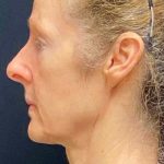 Facelift Before & After Patient #887