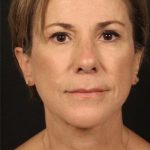 Facelift Before & After Patient #884