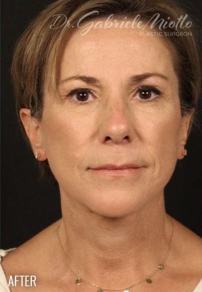 Facelift Before & After Patient #884