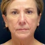 Facelift Before & After Patient #884