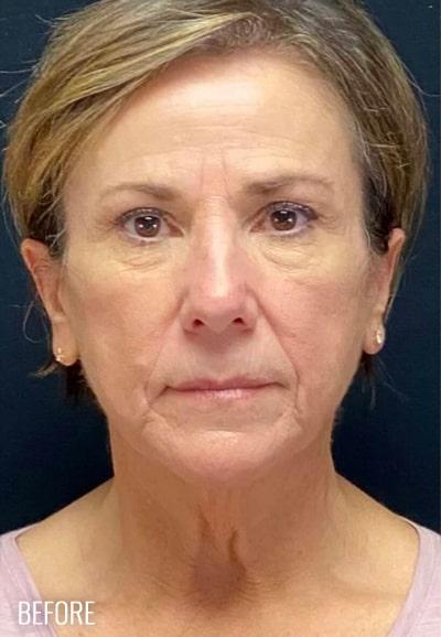 Facelift Before & After Patient #884