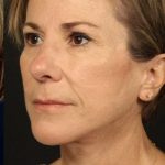 Facelift Before & After Patient #884