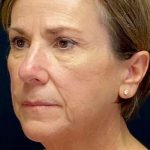 Facelift Before & After Patient #884