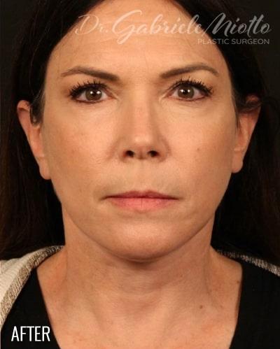 Facelift Before & After Patient #878