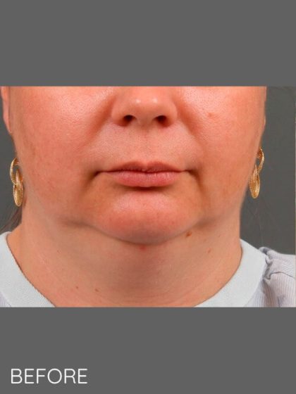 Facial Contouring Before & After Patient #1214