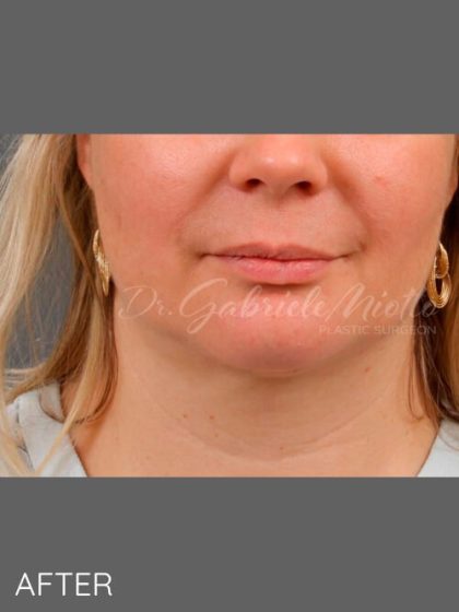 Facial Contouring Before & After Patient #1214