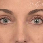 Facial Fat Grafting Before & After Patient #1252