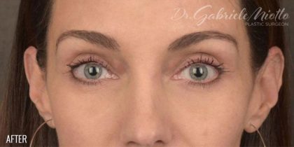 Facial Fat Grafting Before & After Patient #1252