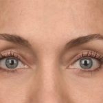 Facial Fat Grafting Before & After Patient #1252