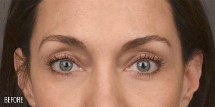 Facial Fat Grafting Before & After Patient #1252